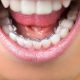 Ortodonta - aparat ortodontyczny Toruń cena - Ortodoncja